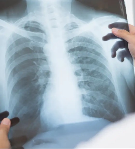 Anvisa aprova novo medicamento para câncer de pulmão avançado